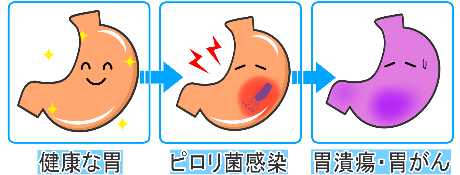 ピロリ菌と胃の内視鏡検査