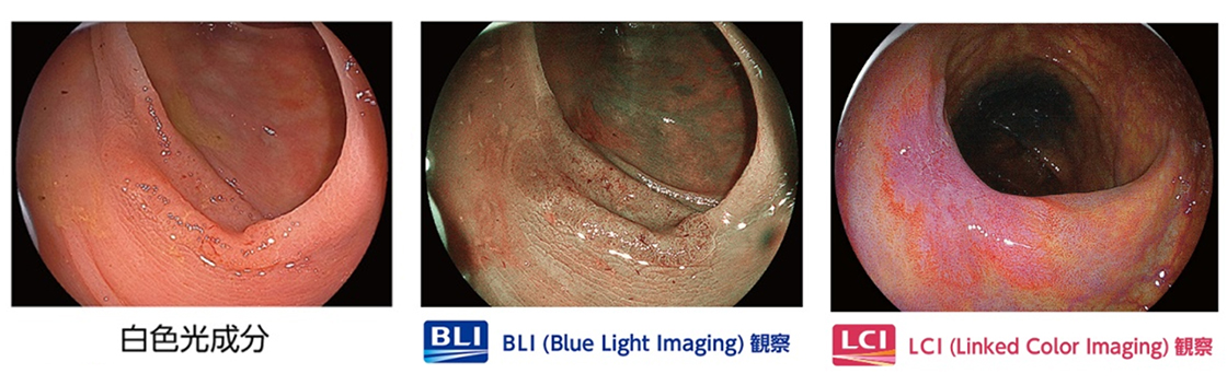 内視鏡白色光、BLI、LCI